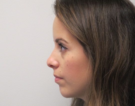 Dr-David-Seidman-Rhinoplasty-Pre-Operation-Tori-3