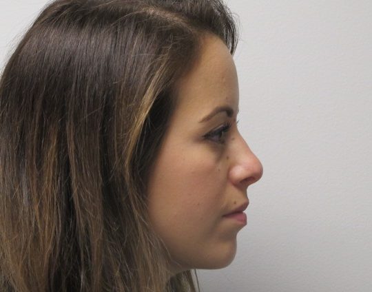 Dr-David-Seidman-Rhinoplasty-Pre-Operation-Tori-5