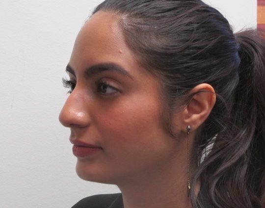 Dr-David-Seidman-Rhinoplasty-Rodriguez-Pre-Operation-11