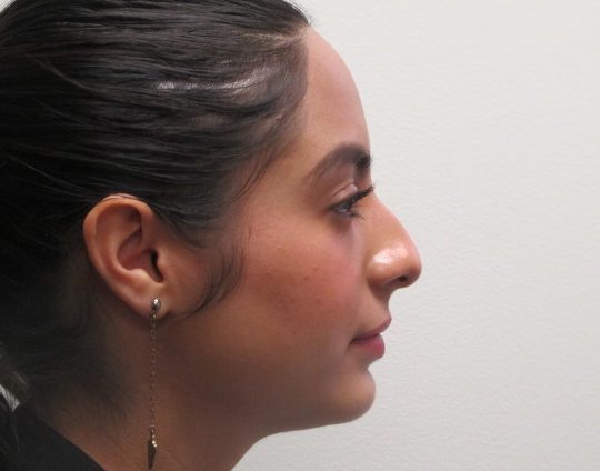 Dr-David-Seidman-Rhinoplasty-Rodriguez-Pre-Operation-4