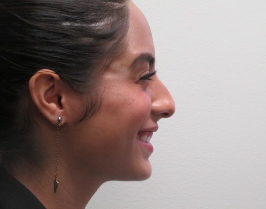 Dr-David-Seidman-Rhinoplasty-Rodriguez-Pre-Operation-5