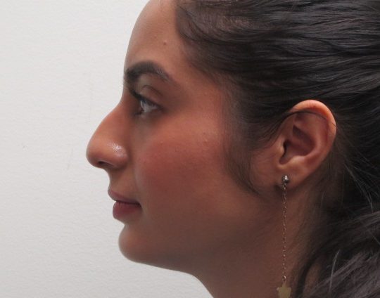 Dr-David-Seidman-Rhinoplasty-Rodriguez-Pre-Operation-6