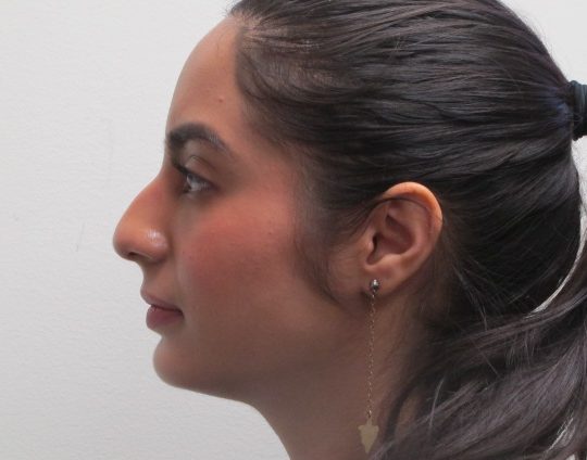 Dr-David-Seidman-Rhinoplasty-Rodriguez-Pre-Operation-7