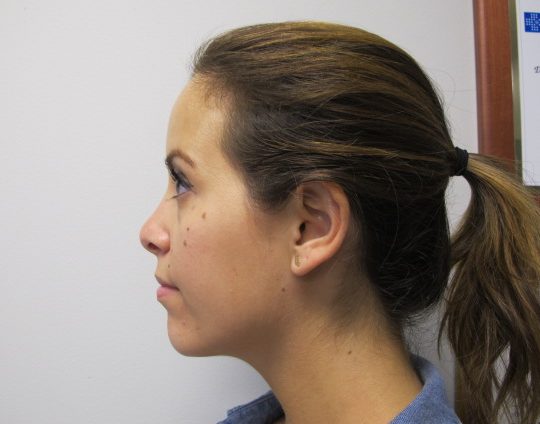 Dr-David-Seidman_Rhinoplasty-Tori-Post-Operation-3