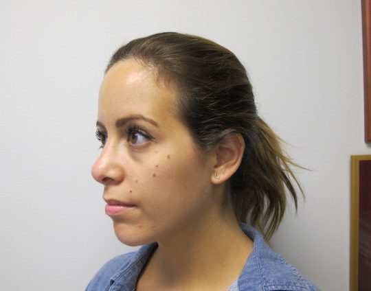 Dr-David-Seidman_Rhinoplasty-Tori-Post-Operation-4