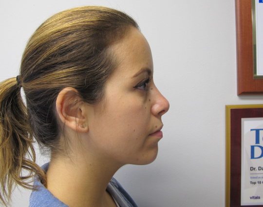 Dr-David-Seidman_Rhinoplasty-Tori-Post-Operation-5