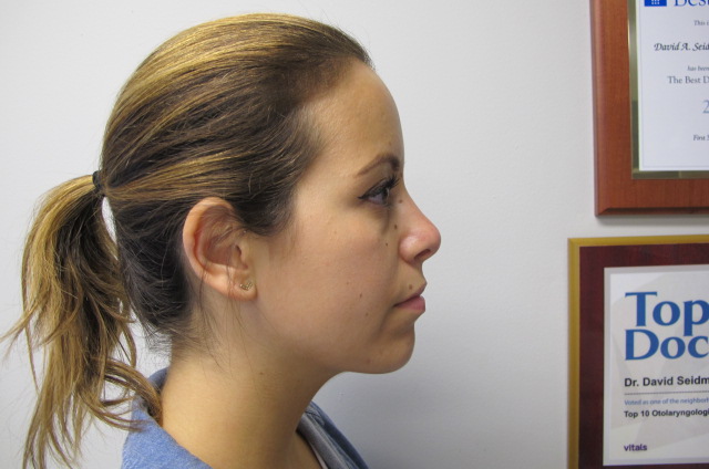 Earlobe Repair - Dr. David Seidman