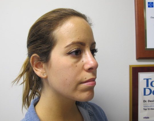 Dr-David-Seidman_Rhinoplasty-Tori-Post-Operation-6