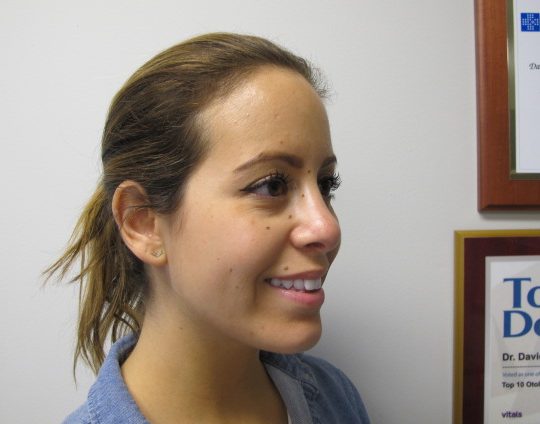 Dr-David-Seidman_Rhinoplasty-Tori-Post-Operation-7